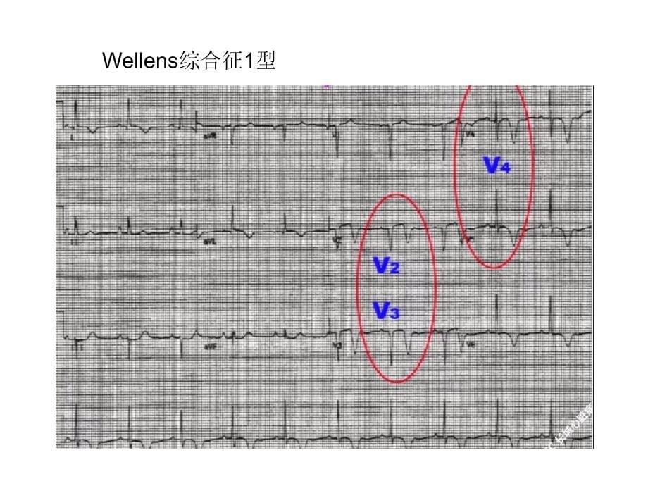 急性心肌梗死不典型图形汇总课件_第5页