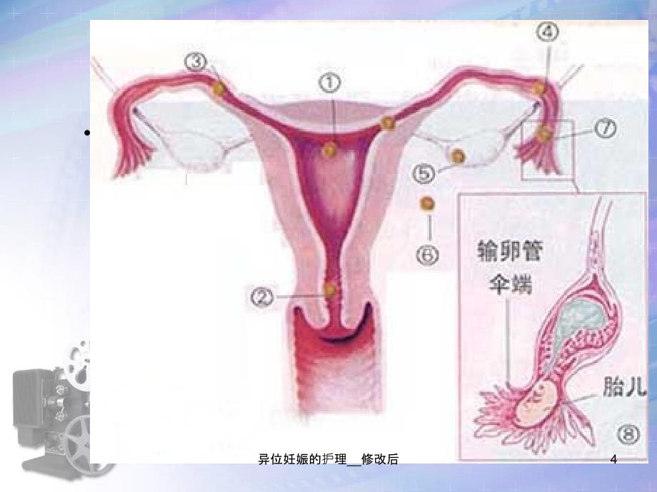 异位妊娠的护理修改后课件_第4页