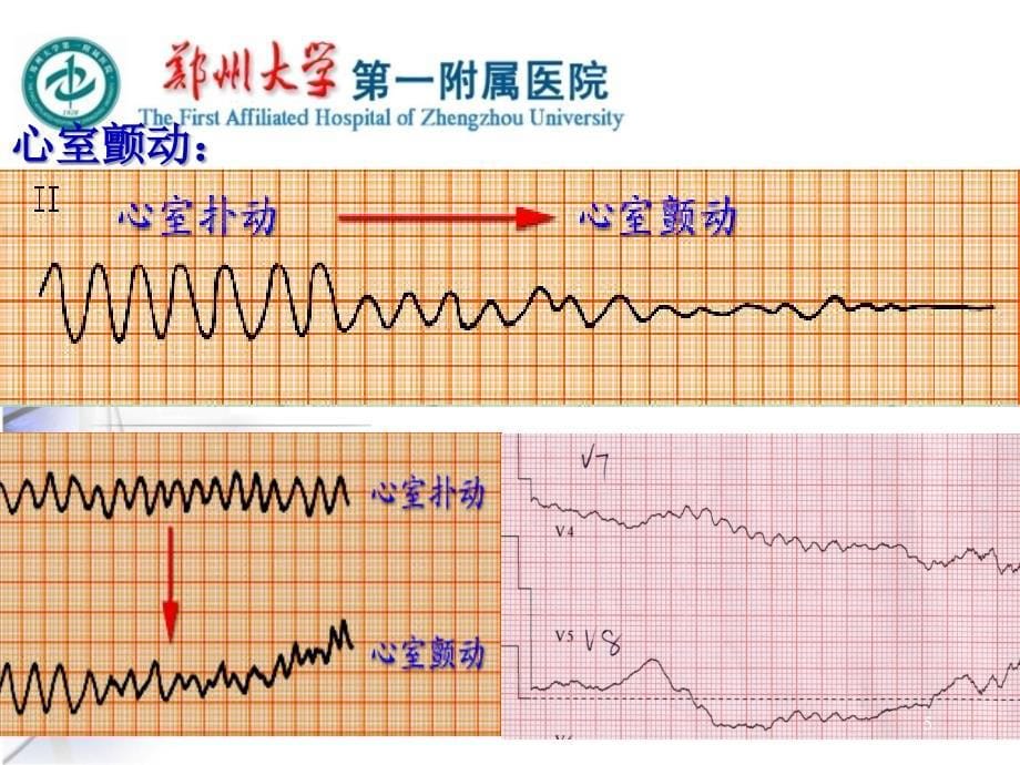 心脏骤停的抢救配合及护理PPT课件_第5页