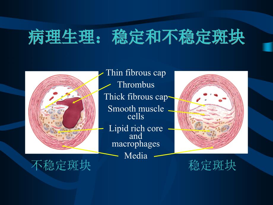 急性冠脉综合征_第4页