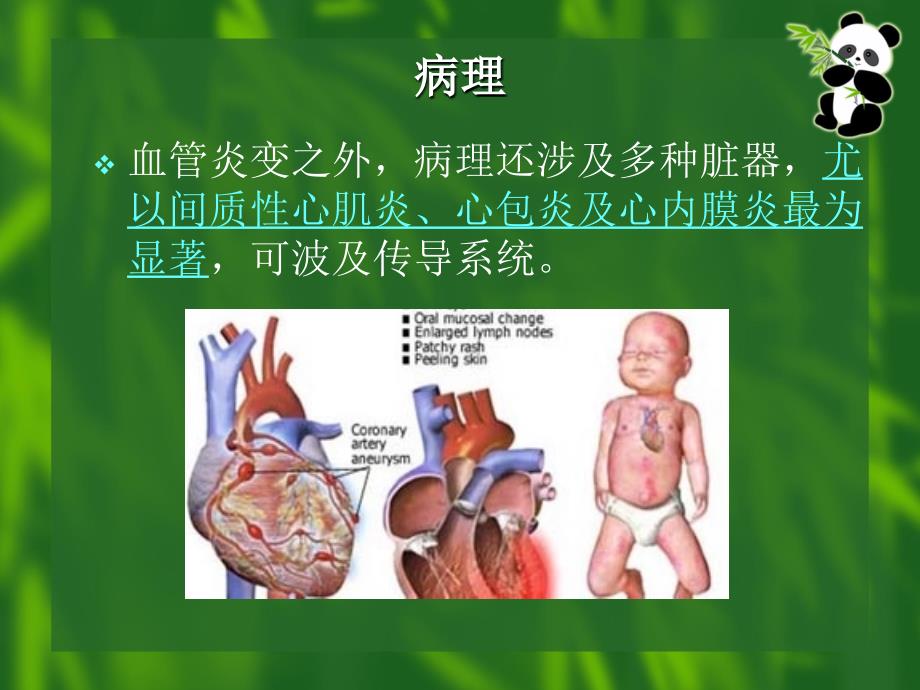 川崎病的护理ppt课件_第4页