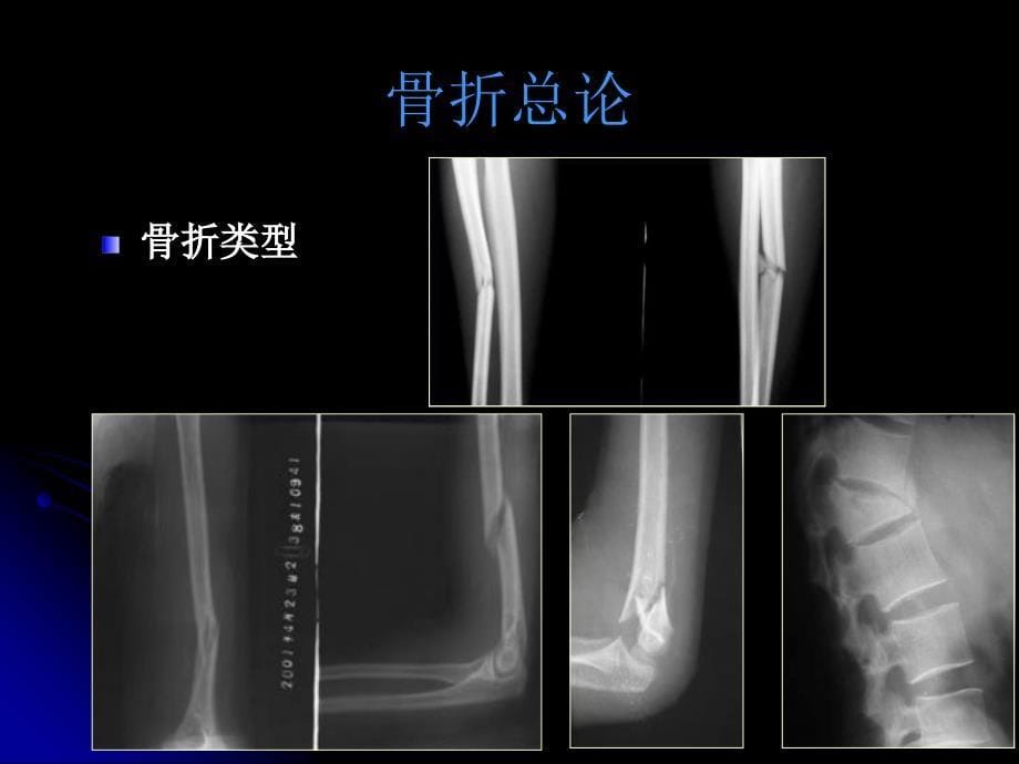 骨关节各论骨折、感染pp阳t课件_第5页