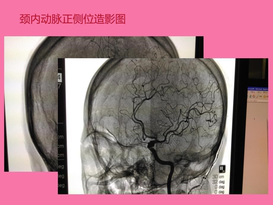 脑血管解剖1ppt课件_第5页