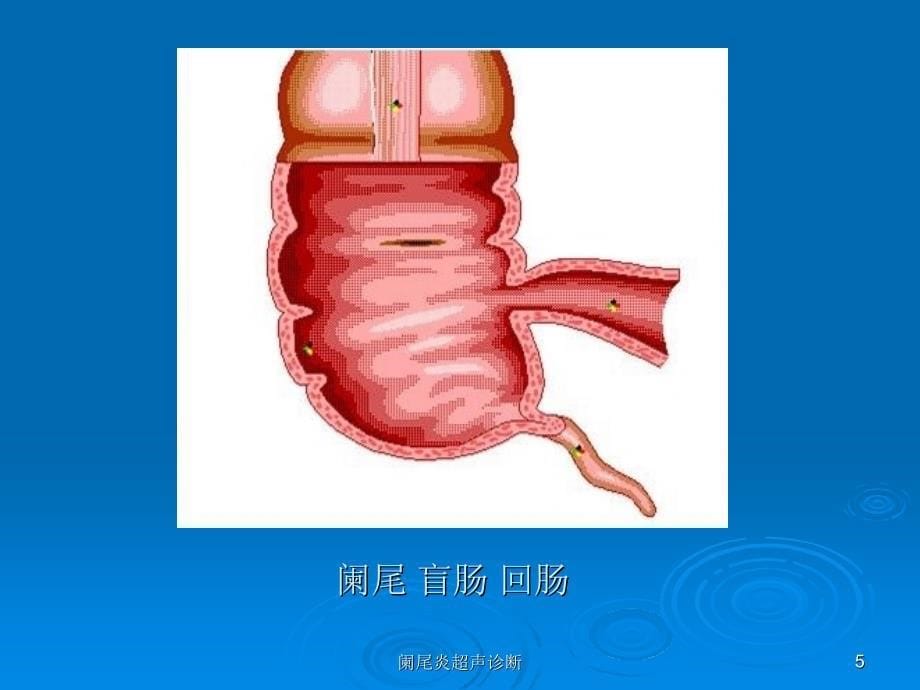 最新阑尾炎超声诊断_第5页