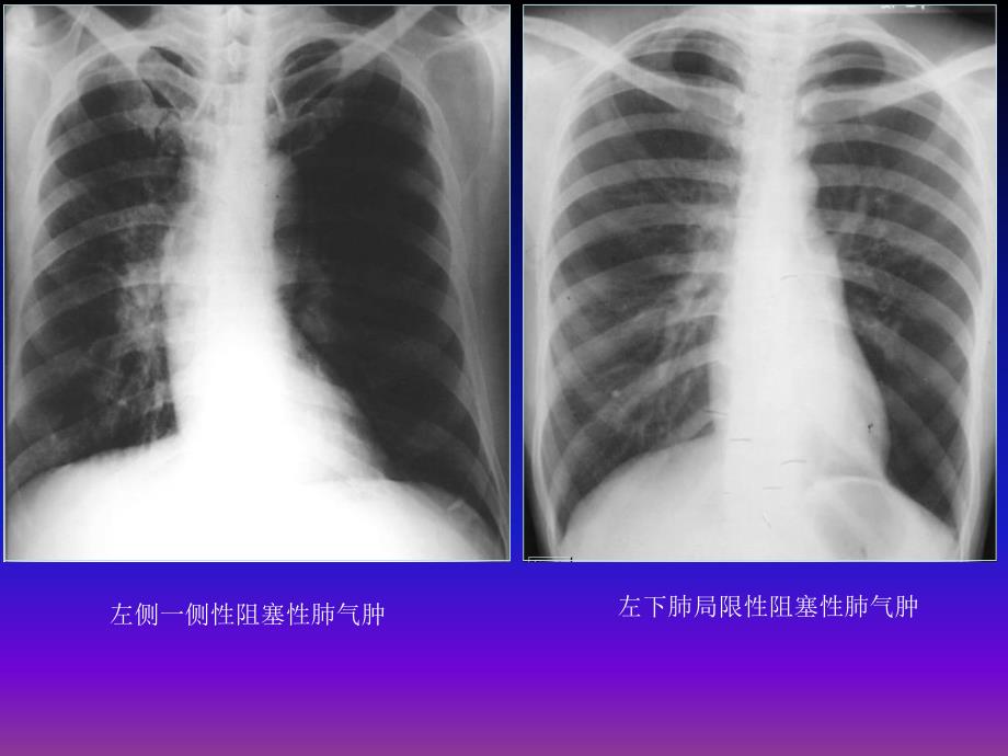 呼吸系统X线基本病变_第3页