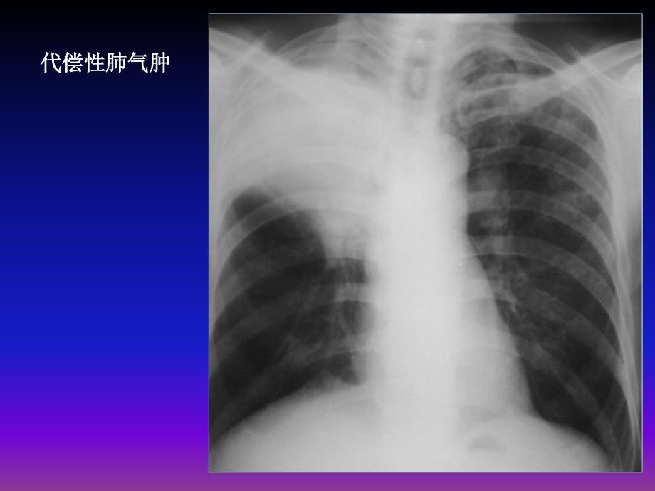 呼吸系统X线基本病变_第4页