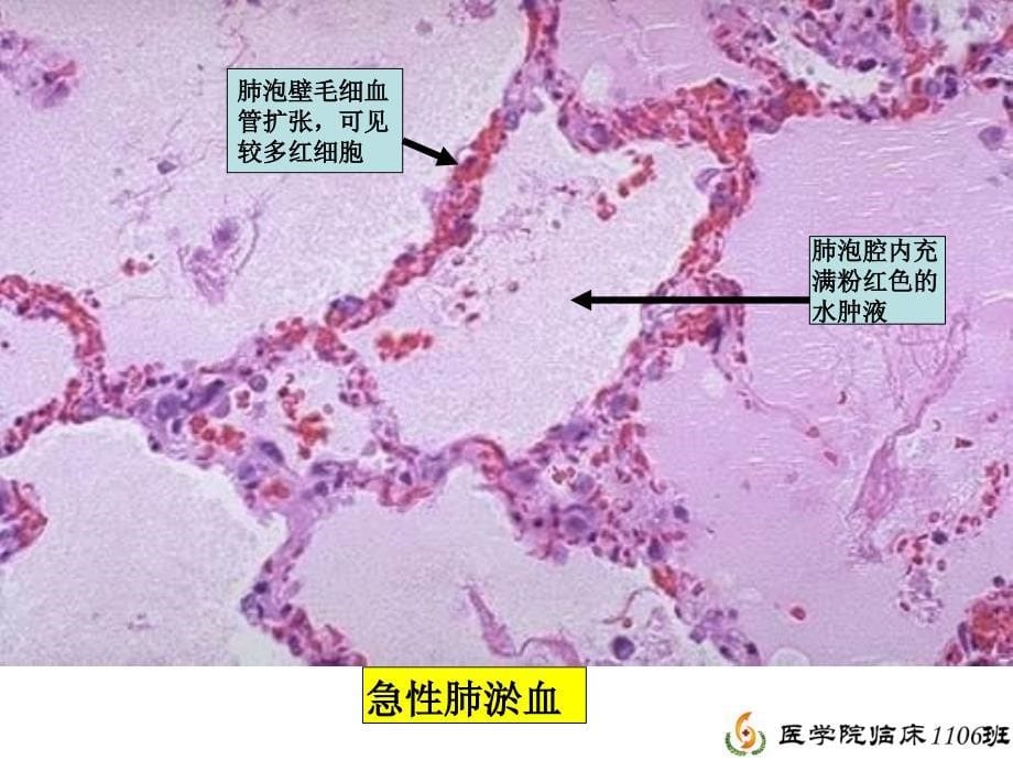 病理学实验总复习(刘勇)_第5页