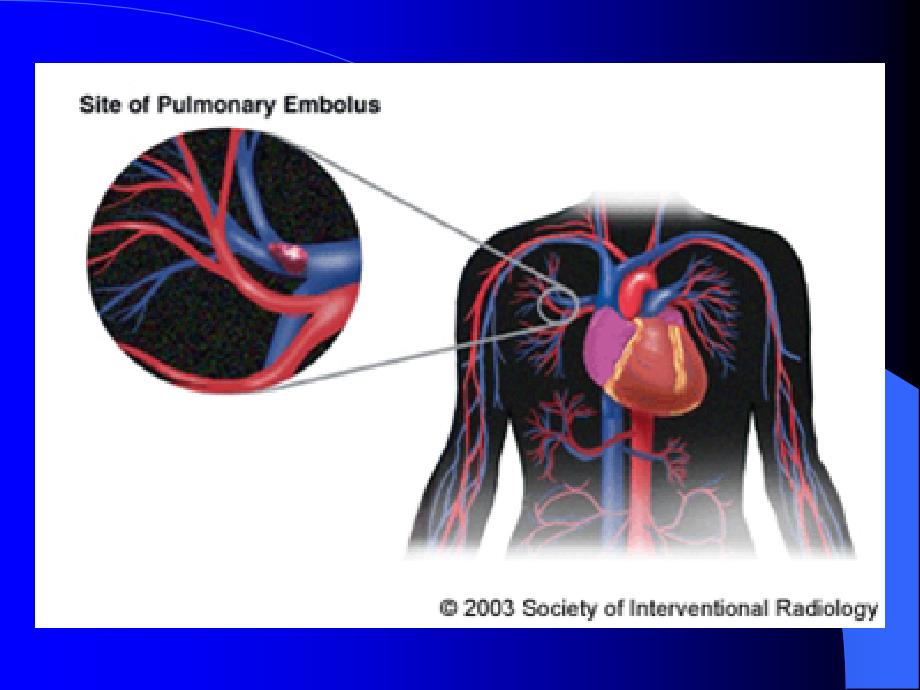 肺栓塞护理查房PPT精_第3页