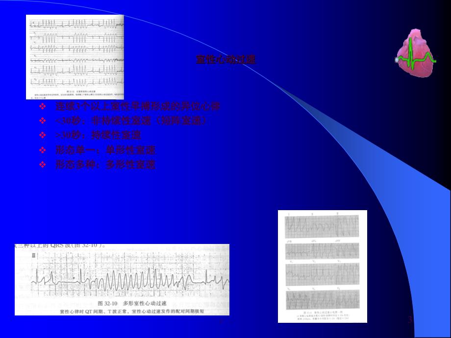 室速心电图ppt课件_第3页