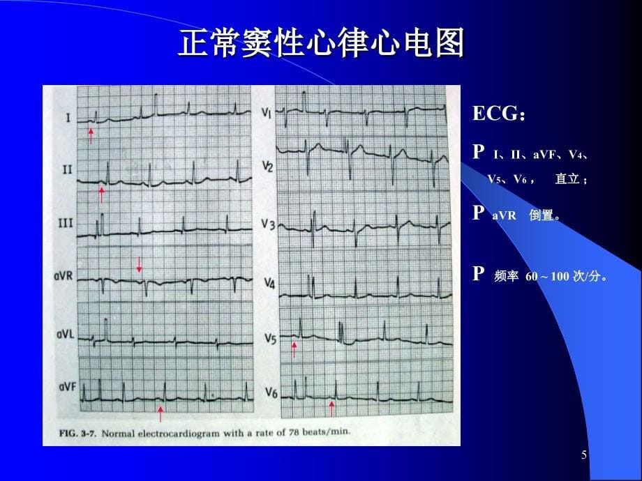 心电图心律失常PPT课件_第5页