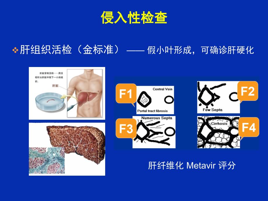 乙肝肝硬化并发症的处理_第4页