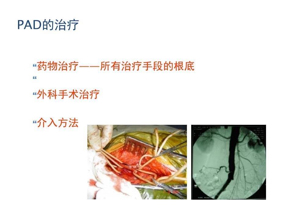 下肢动脉硬化的药物治疗新选择安步乐克_第5页