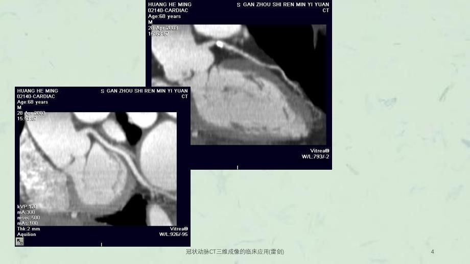 冠状动脉CT三维成像的临床应用(雷剑)课件_第4页