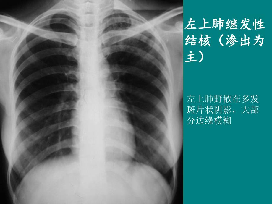 肺结核的影像诊断(X线)_第3页