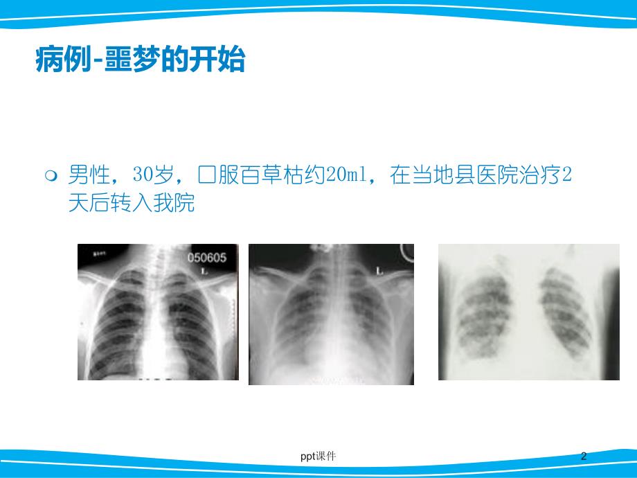 急性百草枯中毒诊治--ppt课件_第2页