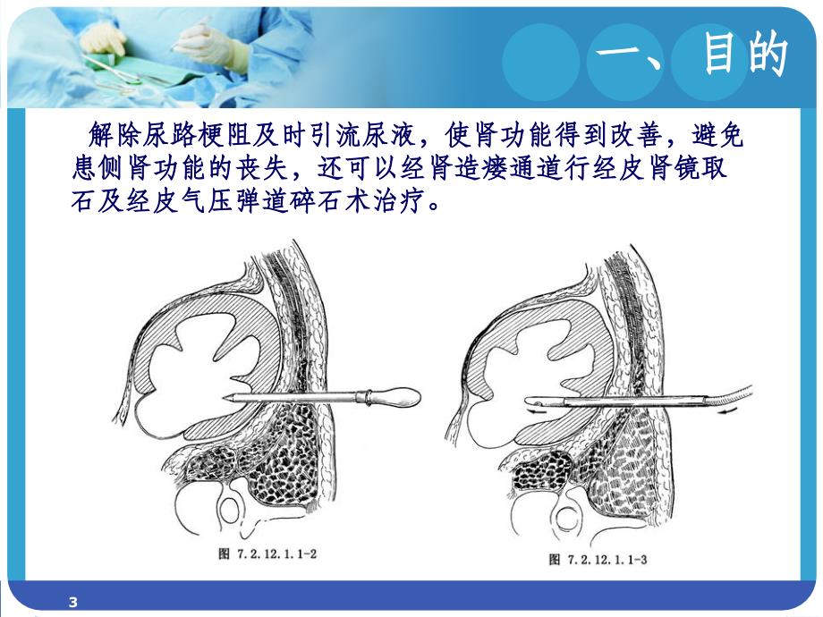 肾穿刺造瘘术的护理.ppt_第3页