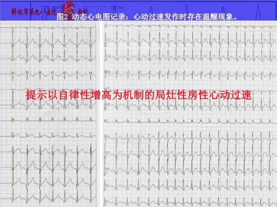 最新左房顶部房性心动过速球囊标测与消融病例PPT课件_第4页