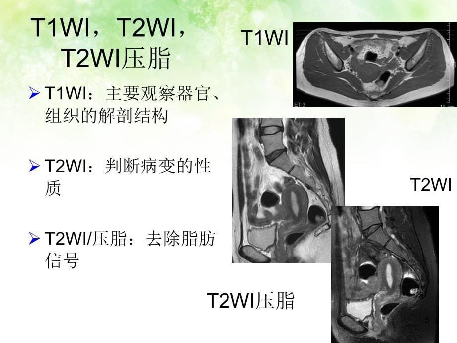 子宫疤痕与疤痕妊娠的MRI诊断ppt课件_第5页