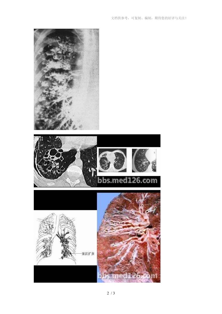 囊性支气管扩张和支气管肺囊肿的影像区别_第2页