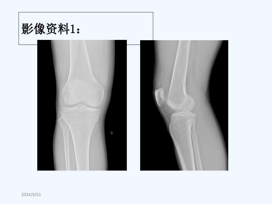 后交叉韧带胫骨止点撕脱骨折_第3页