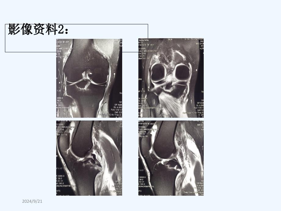 后交叉韧带胫骨止点撕脱骨折_第4页