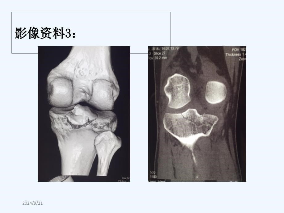 后交叉韧带胫骨止点撕脱骨折_第5页