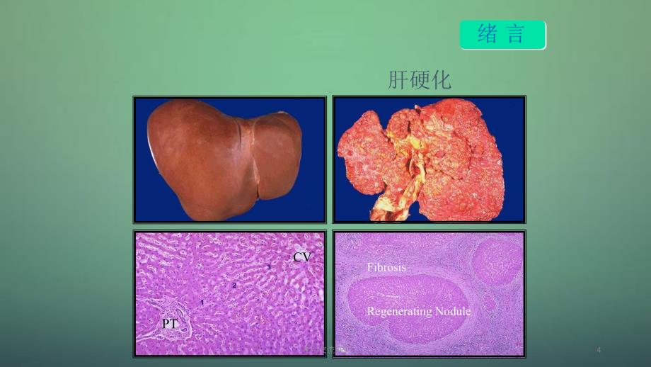 肝硬化治疗的一些进展与共识ppt课件_第4页