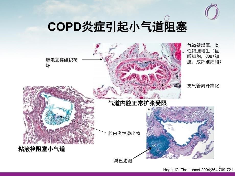 COPD疾病现状ppt课件_第5页