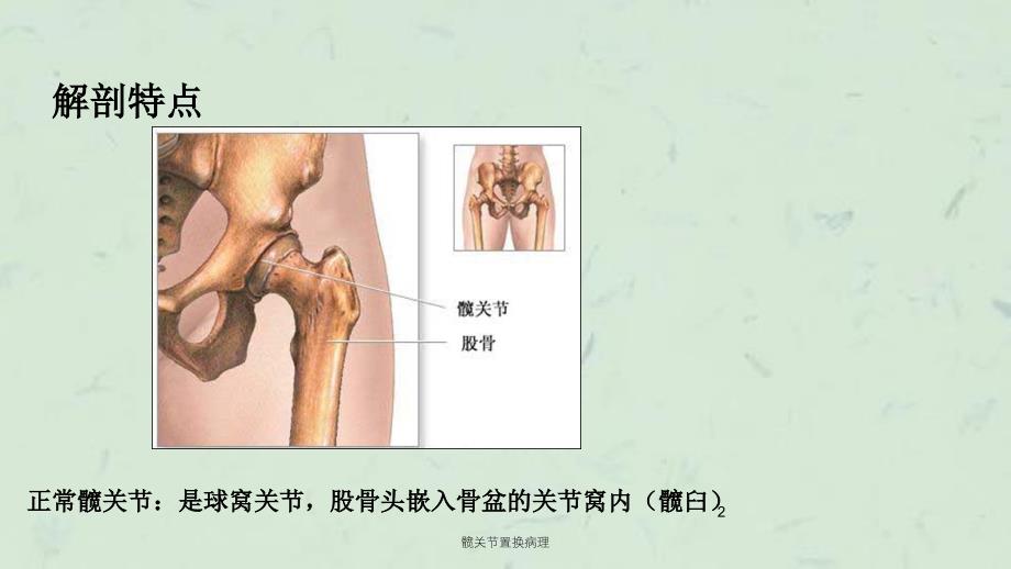 髋关节置换病理课件_第2页