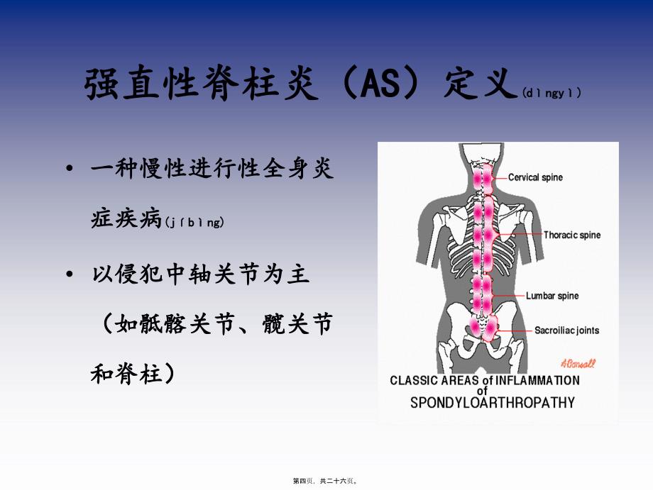 医学专题—强直性脊柱炎与泌尿系结石-刘宇保_第4页