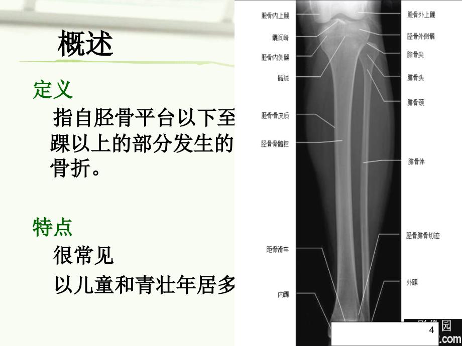 胫腓骨骨折手术配合及访视课件_第4页