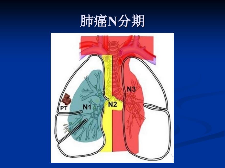 肺癌淋巴结分组ppt课件_第3页