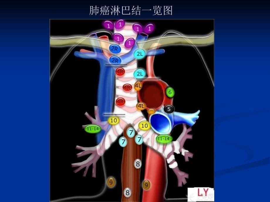 肺癌淋巴结分组ppt课件_第5页