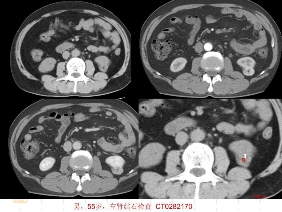 肾脏血管平滑肌脂肪瘤的ct诊断ppt课件_第5页