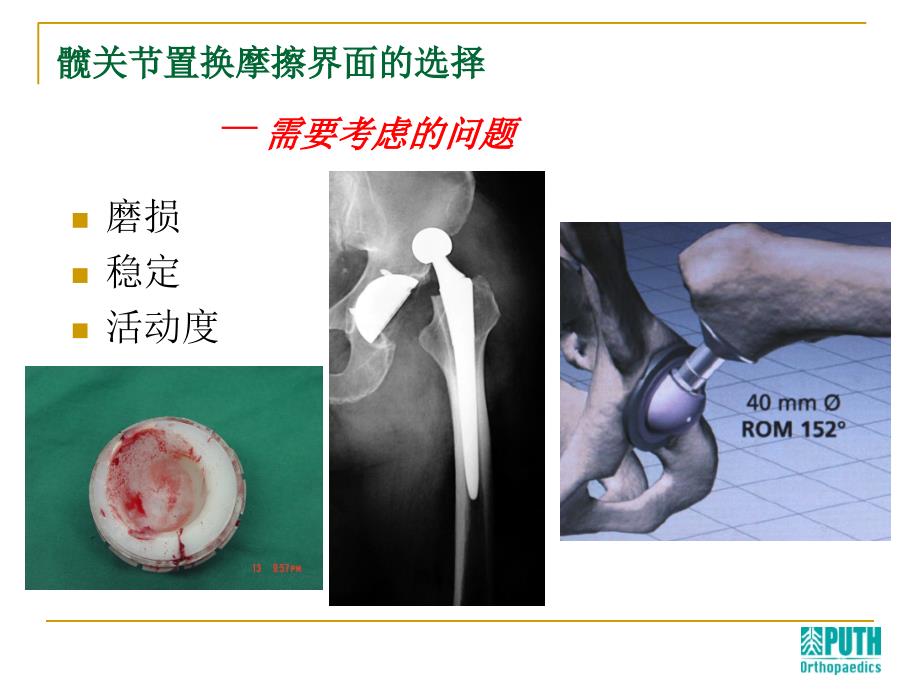 人工关节置换中的一些热点问题_第4页