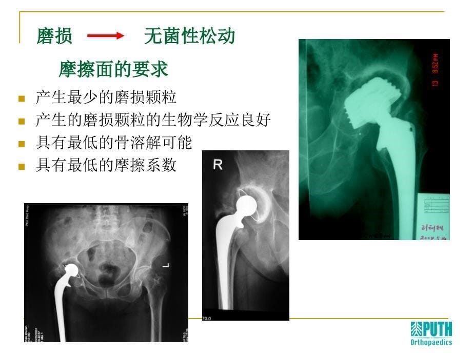 人工关节置换中的一些热点问题_第5页