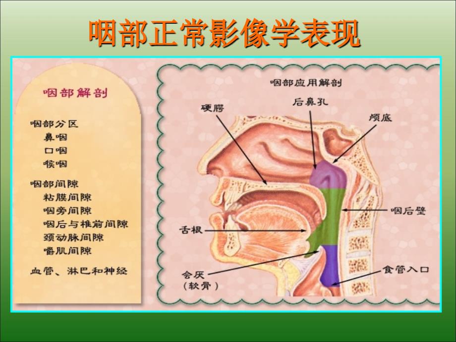 儿童腺样体肥大影像表现及诊断标准优秀课件_第2页