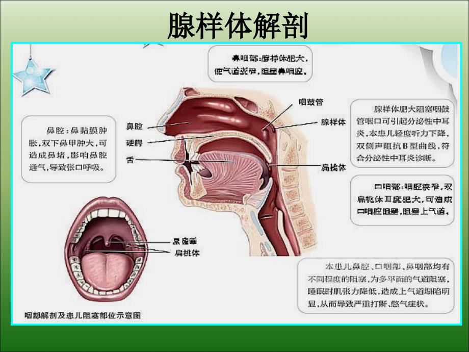 儿童腺样体肥大影像表现及诊断标准优秀课件_第4页