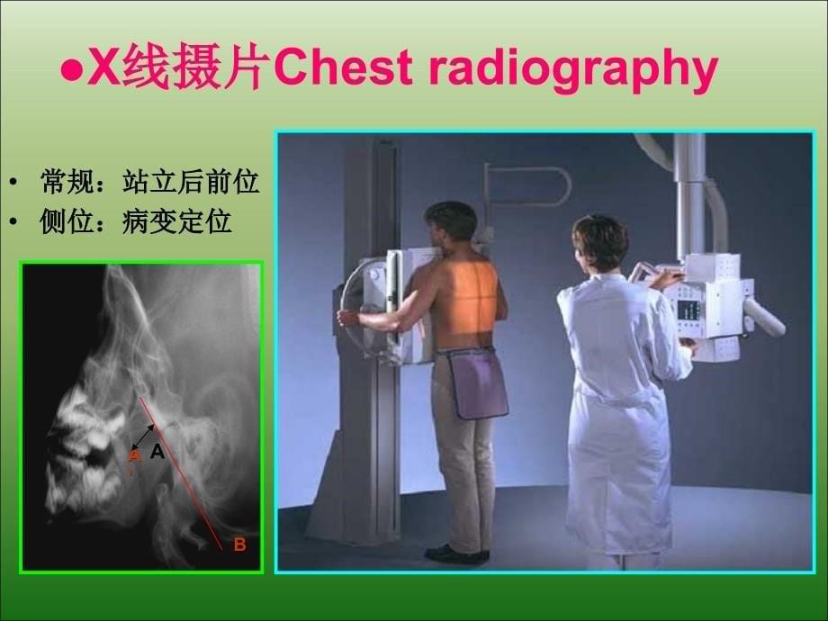 儿童腺样体肥大影像表现及诊断标准优秀课件_第5页