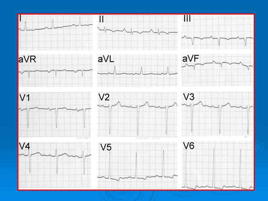 扩张型心肌病的心电图特征_第4页