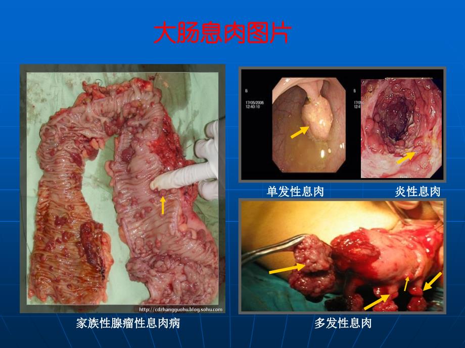 胃肠道息肉ppt课件.ppt_第4页