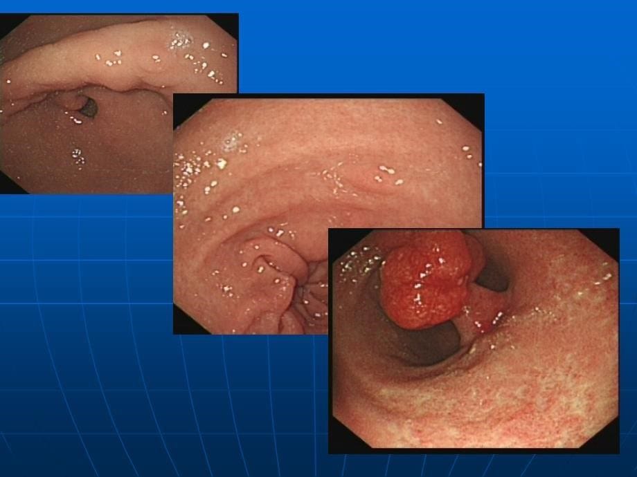 胃肠道息肉ppt课件.ppt_第5页