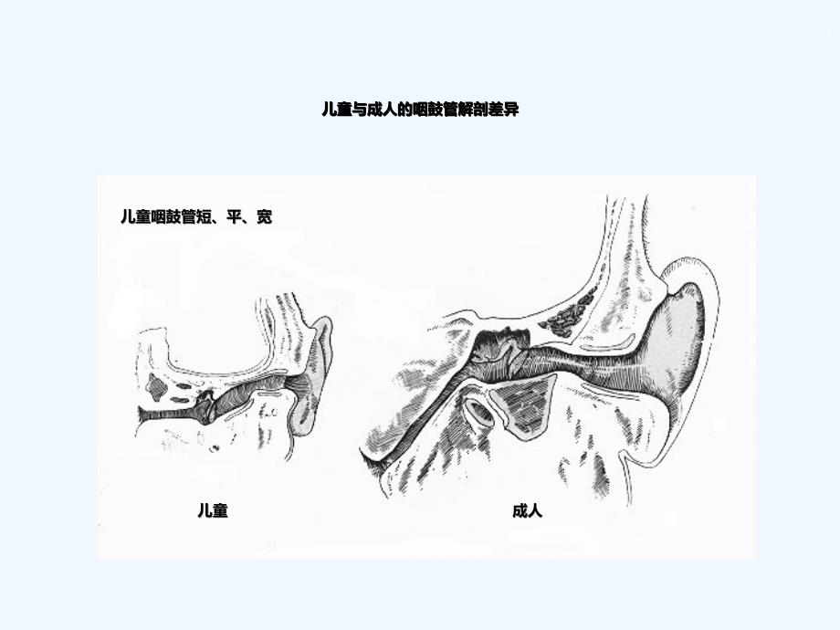 分泌性中耳炎_第5页