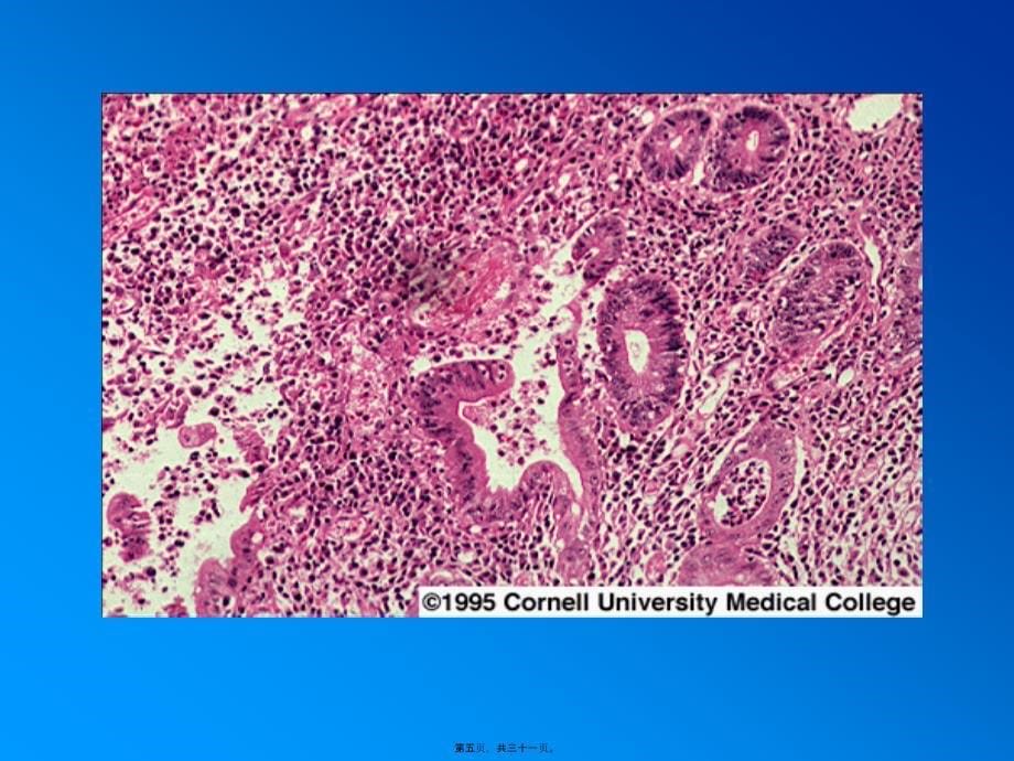 溃疡性结肠炎.9课件_第5页