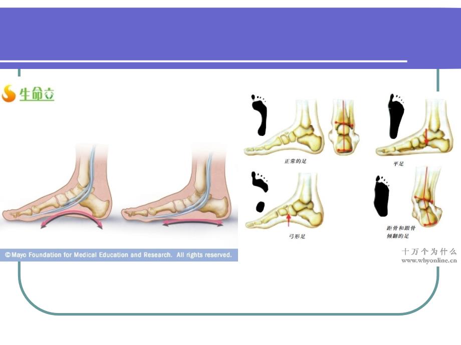 扁平足小讲座_第3页