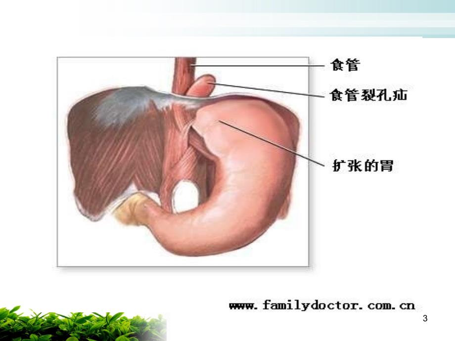 食道裂孔疝护理ppt课件_第3页