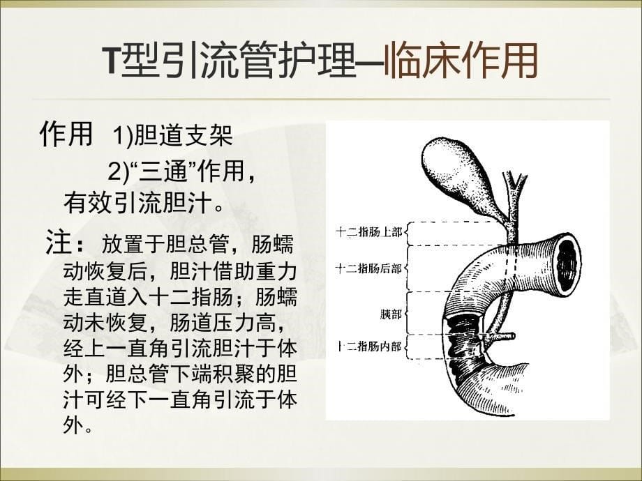 T型引流管护理_第5页