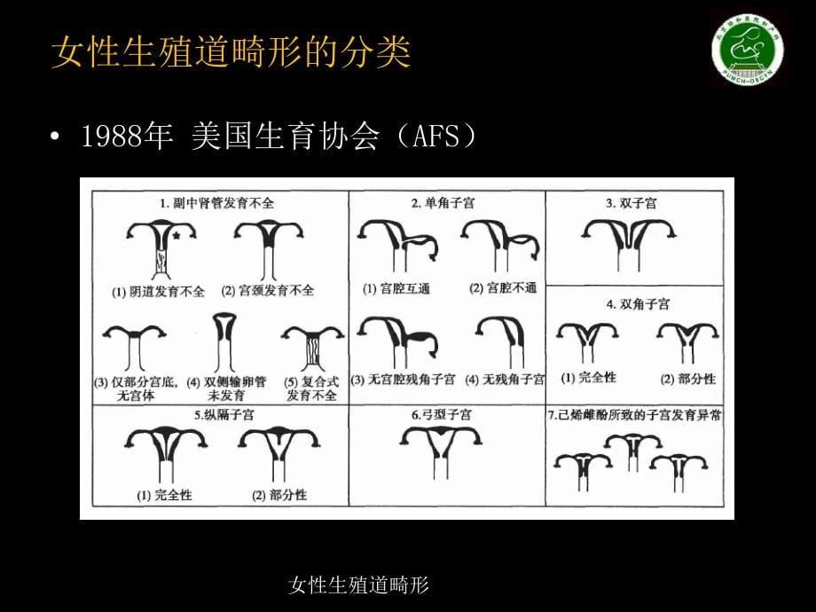 女性生殖道畸形课件_第5页