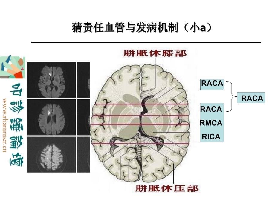 从影像学梗死部位推测责任供血血管.ppt_第5页