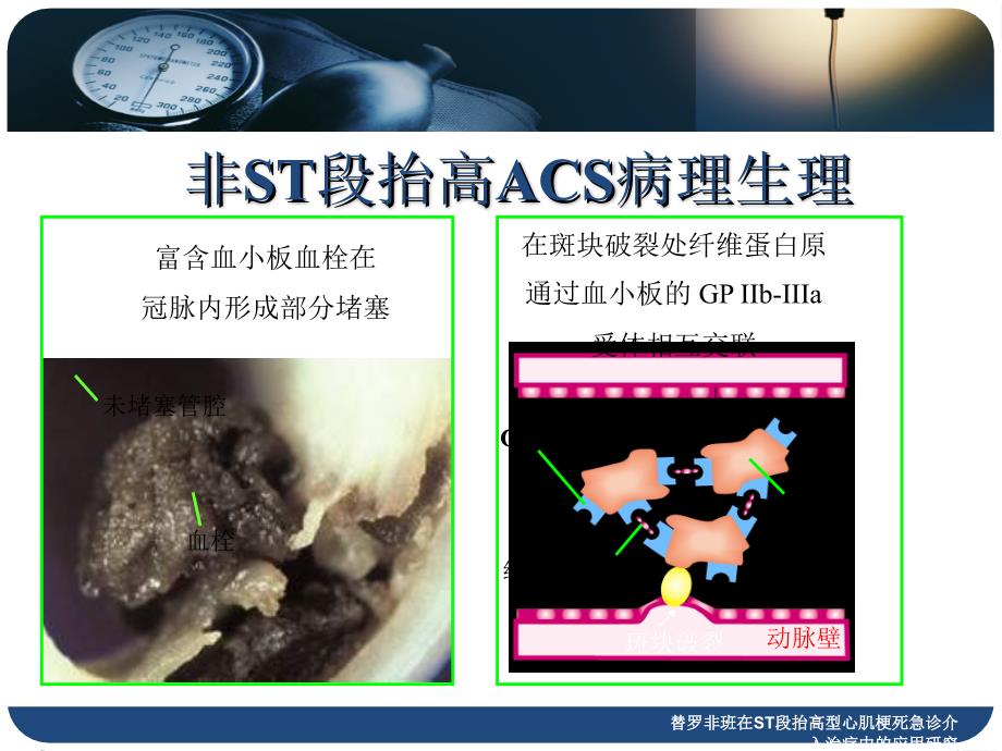 替罗非班在ST段抬高型心肌梗死急诊介入治疗中的应用研究课件_第4页